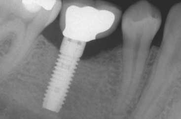 X-RAY of implant with crown