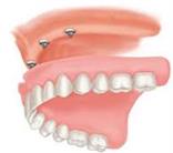 implant supported denture