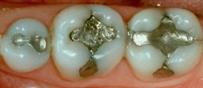 amalgam replacement